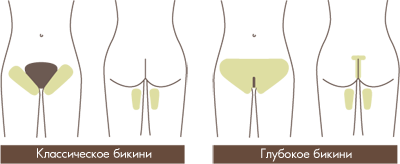 Депиляция зоны бикини
